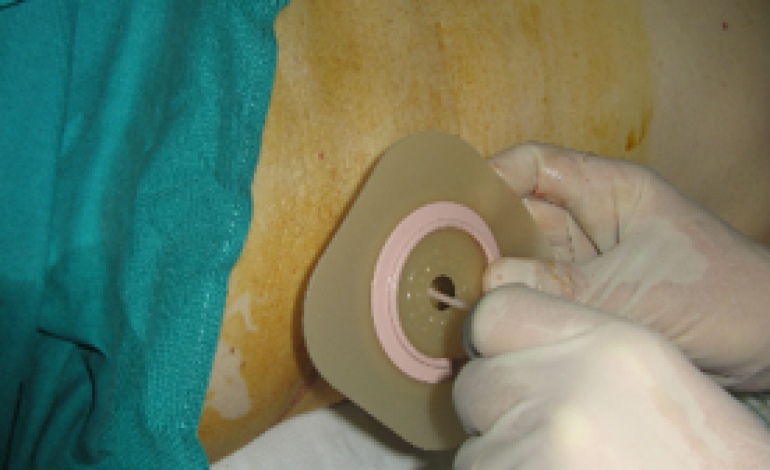 uls-de-leiria-assinala-dia-mundial-da-pessoa-ostomia